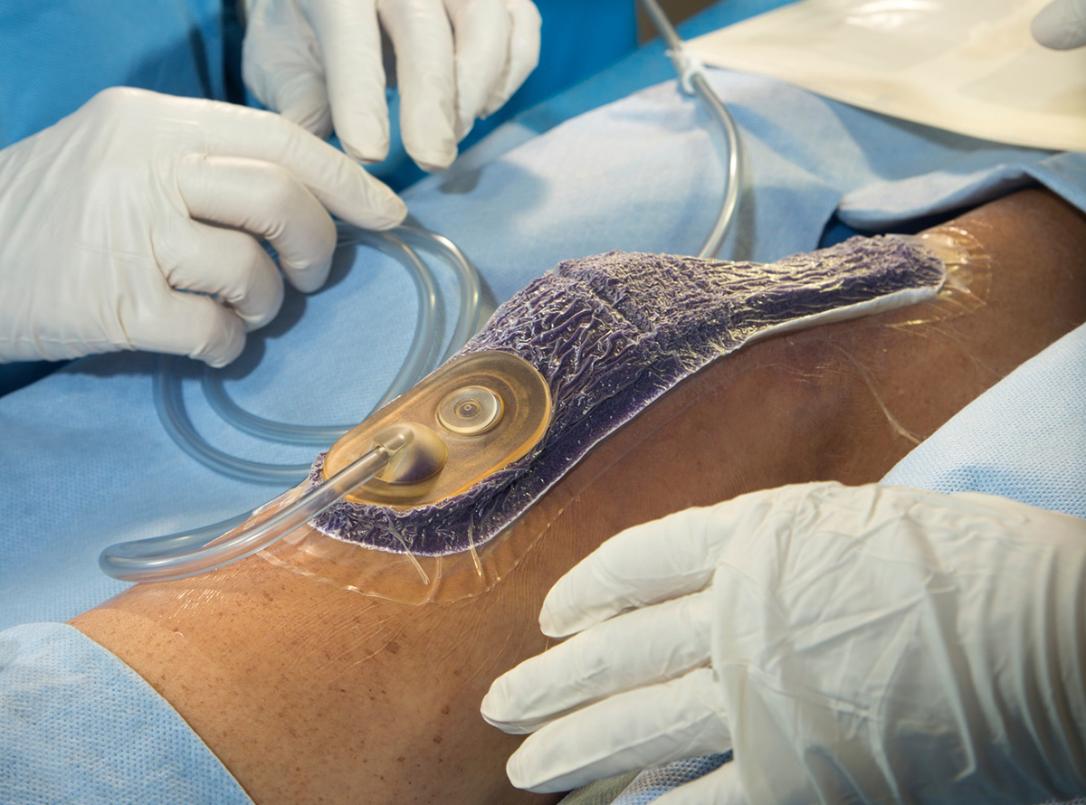 surgery negative pressure wound therapy
