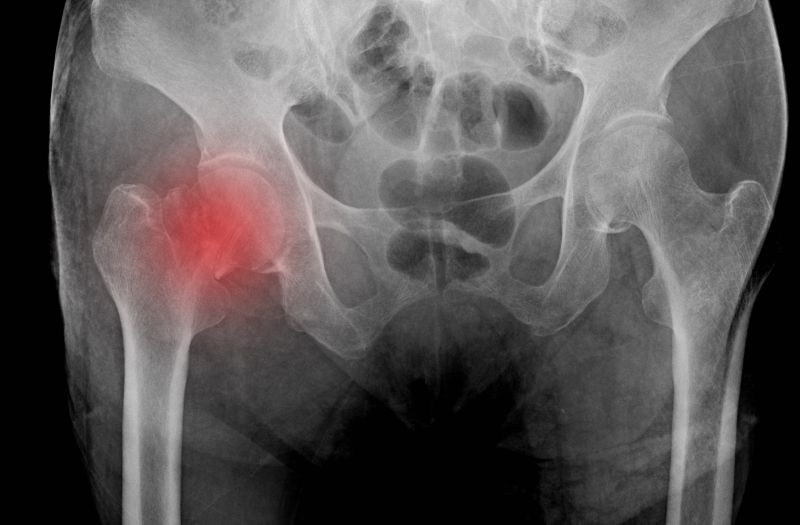 a fractured hip
