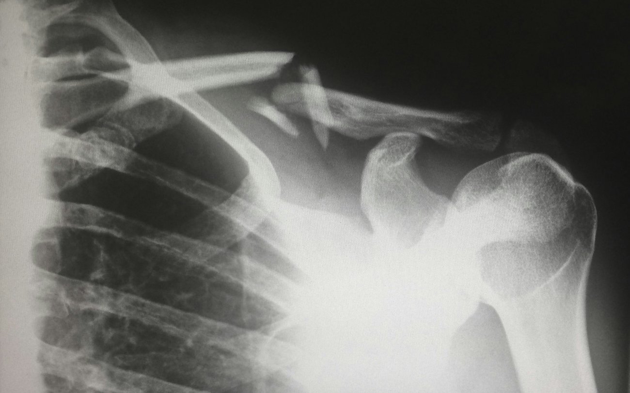 Wound complications in clavicle fracture surgery Wound complications in clavicle fracture surgery
