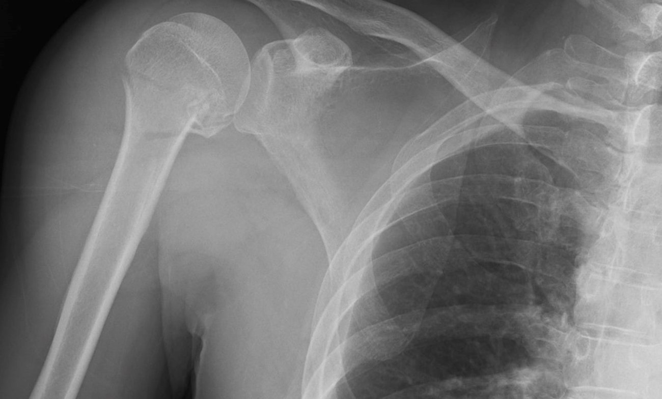 Optimal grafting for proximal humerus fractures Optimal grafting for proximal humerus fractures