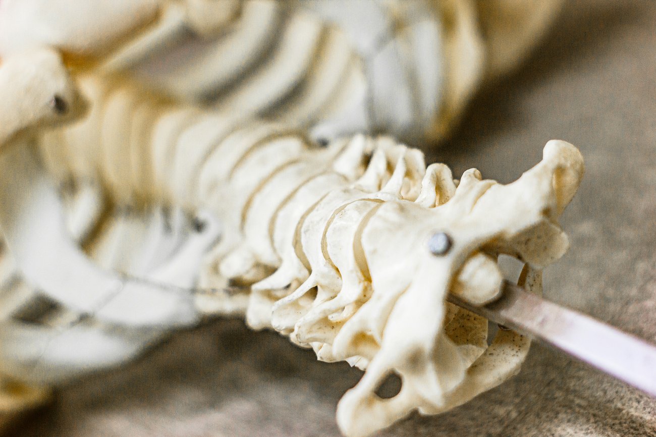 Optimal grafting for proximal humerus fractures Optimal grafting for proximal humerus fractures
