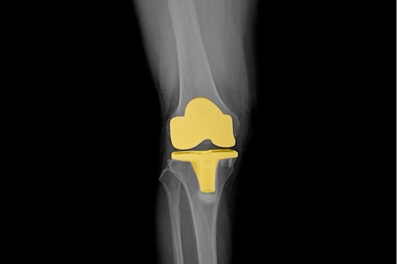Optimal grafting for proximal humerus fractures Optimal grafting for proximal humerus fractures