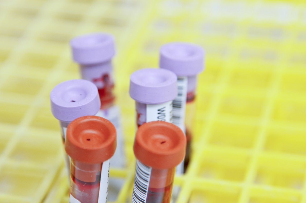 PRP for ankle osteoarthritis?