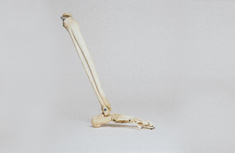 Does ACL surgery cause knee osteoarthritis? Does ACL surgery cause knee osteoarthritis?